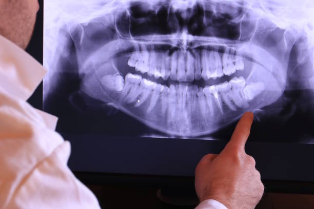 Best Knocked-Out Tooth (Avulsed Tooth) Treatment in Soh Salt Lake, UT